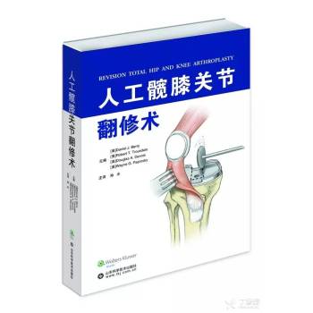 人工髋膝关节翻修术 下载