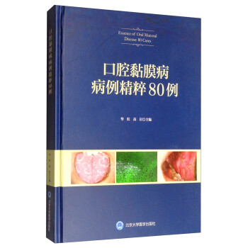 口腔黏膜疑难病例精粹80例 [Essence of Oral Mucosal Disease：80 Cases] 下载